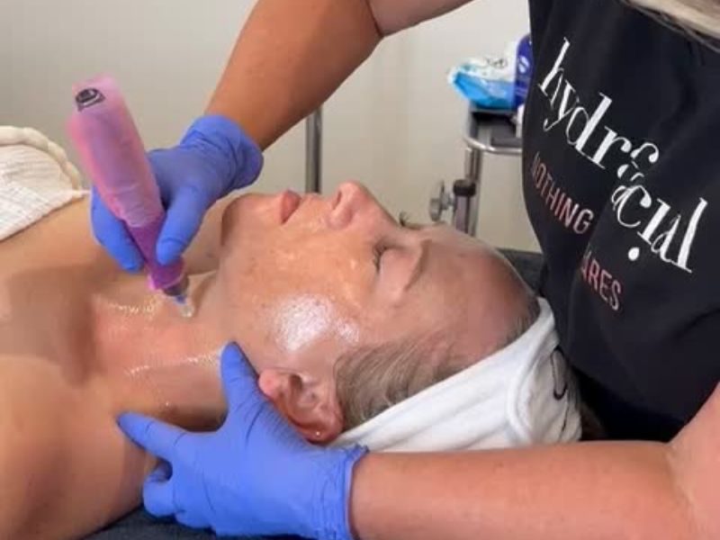 A woman undergoing a microneedling treatment with PRP at a modern spa, illustrating an advanced skincare procedure.